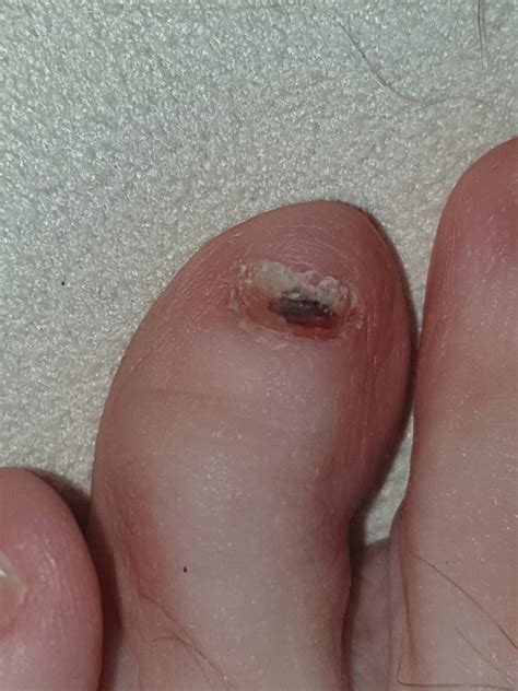 malignes melanom unter nagel